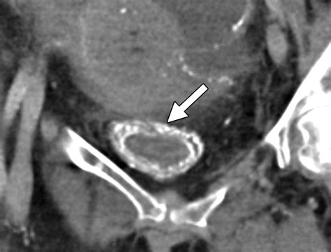 Diagnostic Approach To Benign And Malignant Calcifications In The Abdomen And Pelvis Radiographics