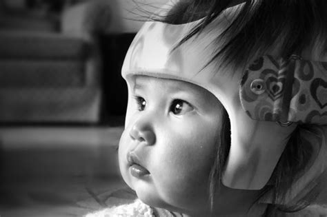 Learning From Japan How To Effectively Treat Plagiocephaly Cranial