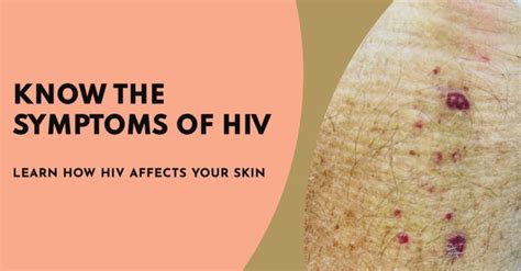 Early Signs Skin First Day Skin HIV1 and HIV2 Symptoms - Healthy Mens