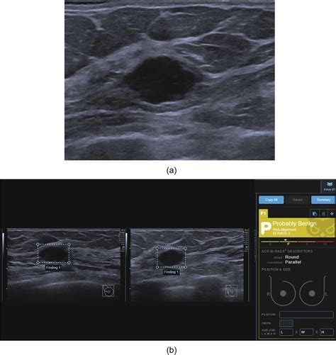 Artificial Intelligence In Bi Rads Categorization Of Breast Lesions On Ultrasound Can We Omit