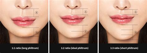 All About Philtrum Reduction Surgery Upper Lip Lift Hyundai