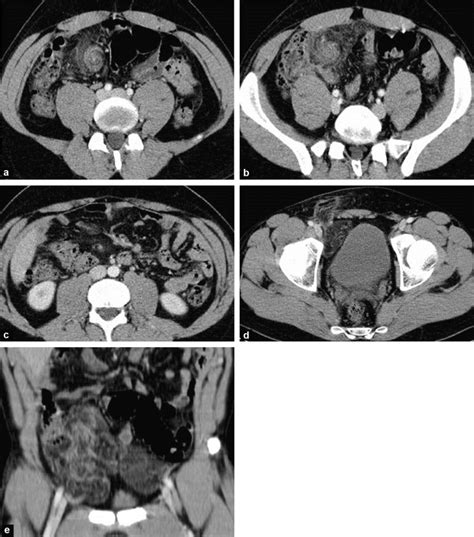 Tdm Abdominale Apr S Injection De Produit De Contraste En Coupes