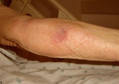 👉 Phlebitis - Pictures, Symptoms, Treatment and Causes (December 2021)