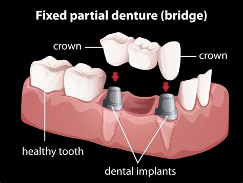 Best Dental Clinic for Crowns and Bridges | Dentaire Smile Studio