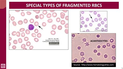 Hematology 2 U1 L8 Cells Are Commonly Seen In Ha Youtube