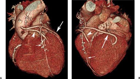 Bypass Grafts Radiology Key