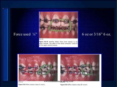 Elastics In Orthodontics Certified Fixed Orthodontic Courses By Indi