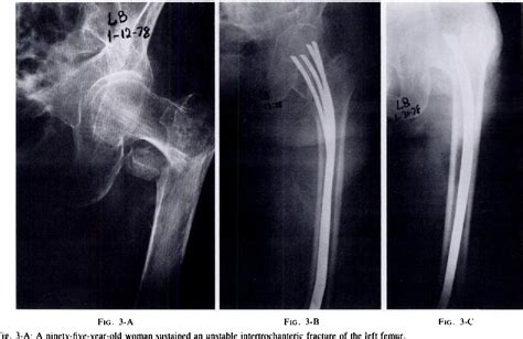 Figure From Ender Nailing Of Intertrochanteric And Subtrochanteric