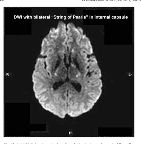 Figure From Susac S Syndrome Update Semantic Scholar