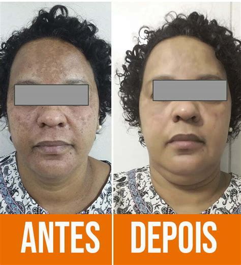 Melasma Antes E Depois Veja O Resultado Do Tratamento Com Laser Co2