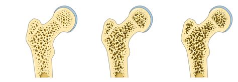 Osteoporosis Y Osteopenia Qué Es Causas Síntomas Y 47 Off