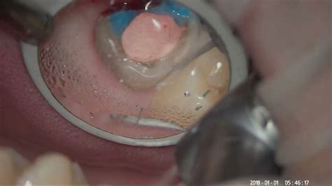 Maxillary Molar Crown Preparation Proximal Reduction Under Mirror View Youtube