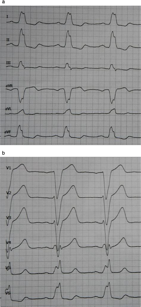 Pseudo Wellens Syndrome And Intermittent Left Bundle Branch Block In