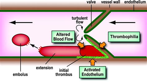 Venous Thromboembolism A Need For More Public Awareness And Research