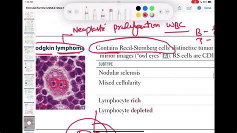 Hodgkin Lymphoma Types Haematology 72 First Aid Usmle Step 1 In Urdu Hindi Youtube