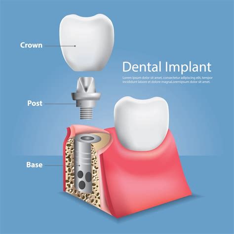 Premium Vector Human Teeth And Dental Implant Vector Illustration