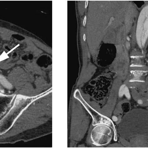 A Year Old Man With Stanford Type A Double Barreled Aortic