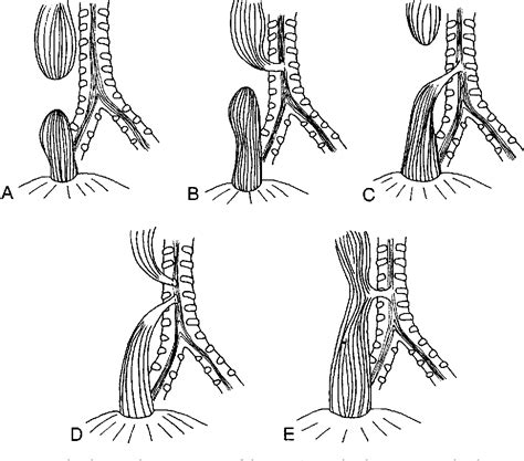 Tracheoesophageal Fistula Semantic Scholar