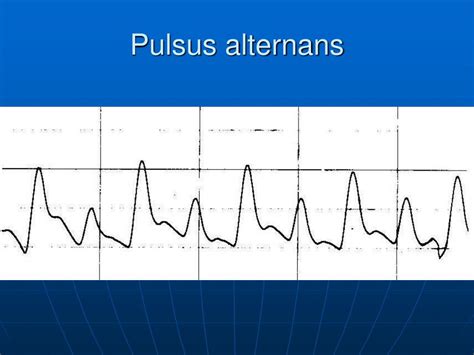 PPT Invasive Blood Pressure Monitoring In Critical Care PowerPoint