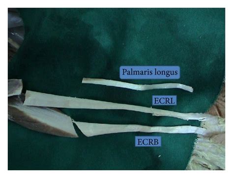 Ecrl Ecrb And Palmaris Longus Tendons Download Scientific Diagram