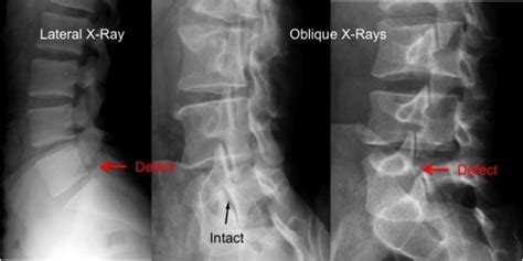 Spondylolysis - Dr. James Manzanares