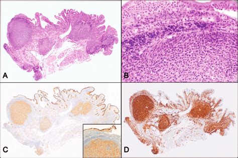 Duodenal Follicular Lymphoma A The Lamina Propria Is Expanded By Download Scientific Diagram