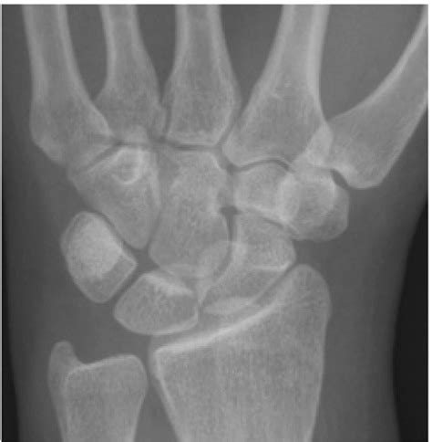 X Ray Image Of Carpal Bones Diagram Quizlet