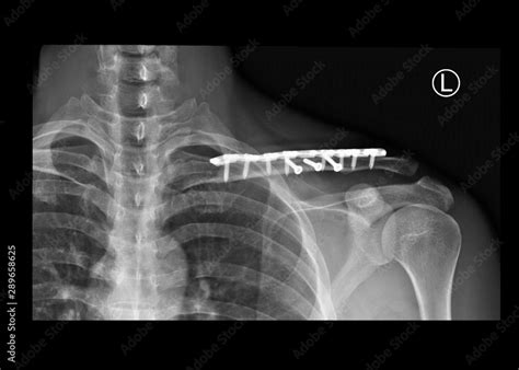 Stockfoto Med Beskrivningen Film X Ray Shoulder Radiograph Showing