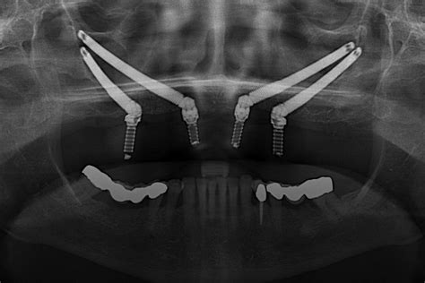 Implantes Cigom Ticos Qu Son Cu Les Son Sus Ventajas Medident