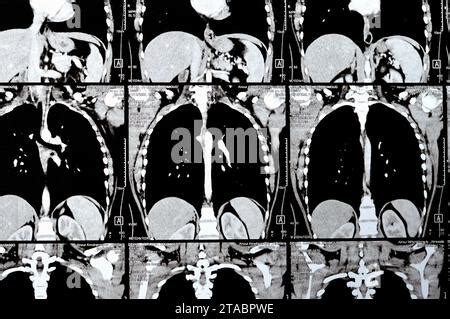 Contrast Chest Computed Tomography CT Scan Of 54 Year Old Female