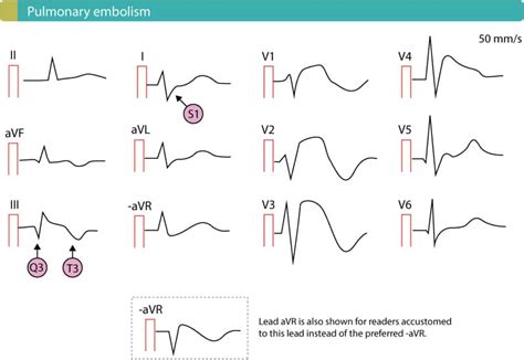 St Segment Elevation In Acute Myocardial Ischemia And Differential Diagnoses Ecg Learning