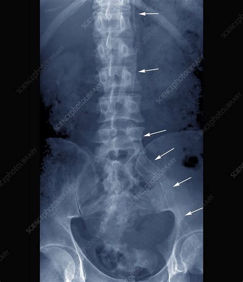 Stents To Treat Aortic Aneurysms X Ray Stock Image C0095459