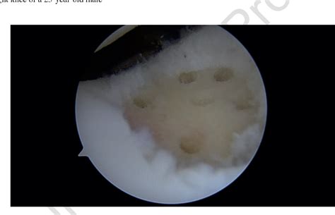 Figure 5 2 From Osteochondritis Dissecans Of The Knee Semantic Scholar