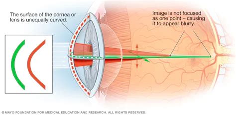 How Laser Eye Surgery Corrects Astigmatism - Optilase