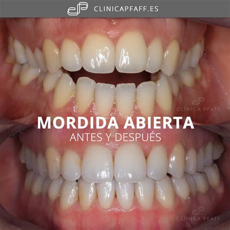 Invisalign Antes Y Despues De La Mordida