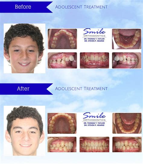 Before & After Patient Photos - Smile Suffolk Braces | Suffolk, VA ...