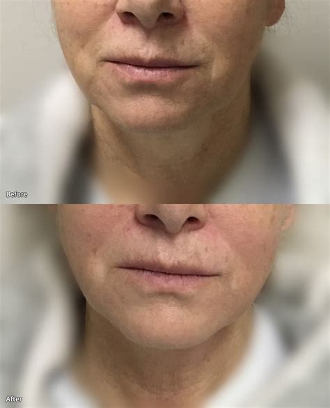 Fotona 2d Tightening Before And After 1 Treatment Session Radiance