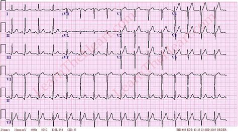 Early Repolarization Ecg Example 2