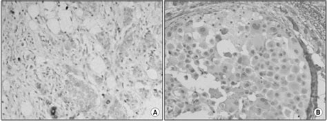 A And B A Hcg Immunoreactivity Was Focally Expressed Within The Download Scientific Diagram