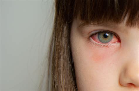 Pink Eye Vs Stye How To Tell The Difference