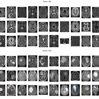 Pdf Brain Tumor Detection Using The Vgg Model A Deep Learning