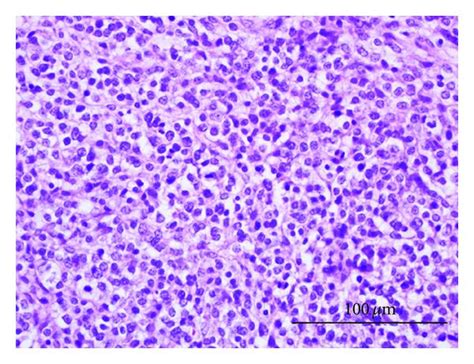 Histological Section Of A Poorly Differentiated Sarcoma Neoplastic