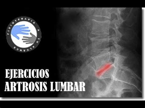 Artrosis Lumbar Ejercicios Para Aliviar El Dolor Y Prevenir La