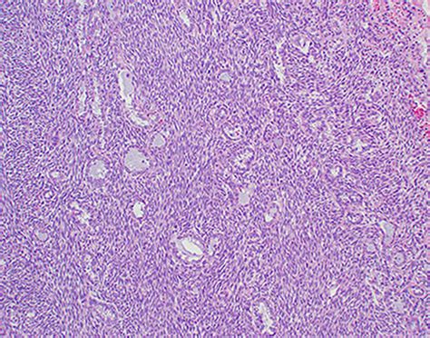 Biphasic Synovial Sarcomas Contain Epithelioid Elements Here In The