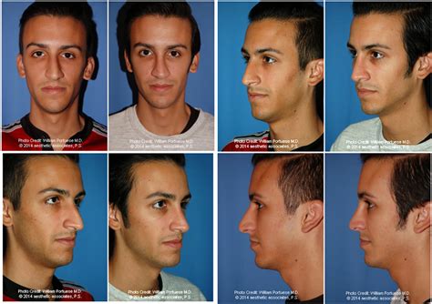 Down Turned Tip Nose Before And After Photo Gallery Nose Surgery Photos