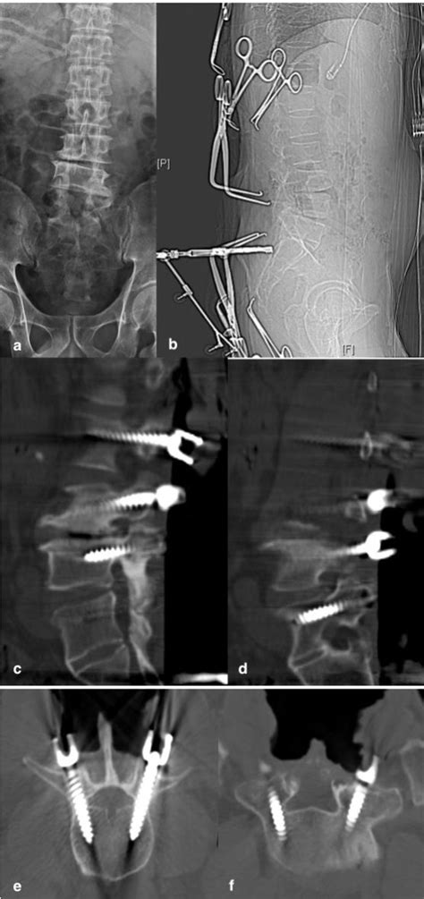 Figure 2 From High Accuracy And Safety Of Intraoperative CT Guided