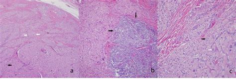 Figure 1 From Testicular Adrenal Rest Tumors In A Patient With