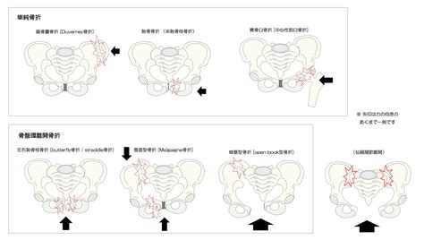 Https Houigaku Blog Houigakublog Pelvic Fractures