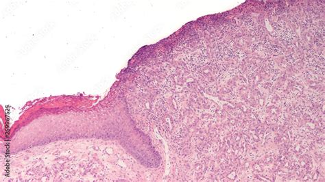 Pyogenic Granuloma Histology