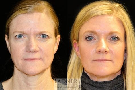 Eyelid Surgery Before And After Expo Mistery